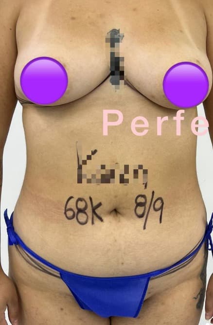 Antes - Definición Abdominal