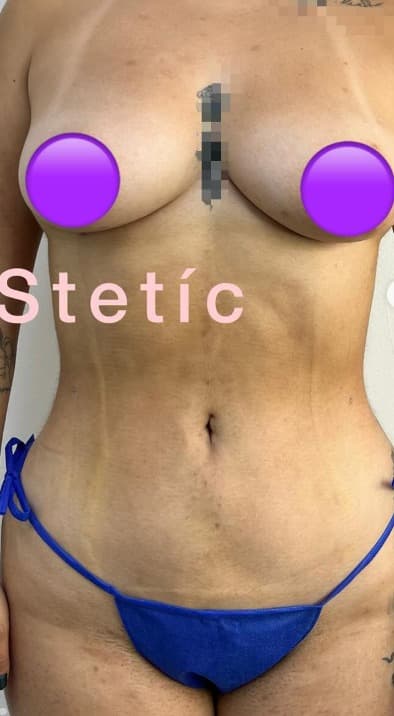 Después - Definición Abdominal