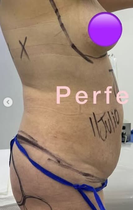 Antes - Tonificación Láser