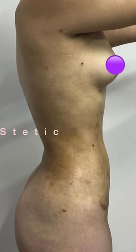 Después - Moldeamiento Corporal