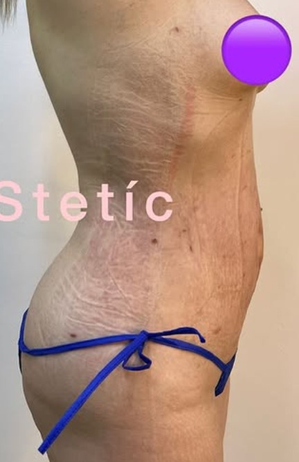 Después - Moldeamiento Corporal